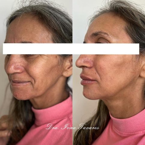 Dra. Ivna Tavares: Revolucionando a harmonização facial em Acopiara