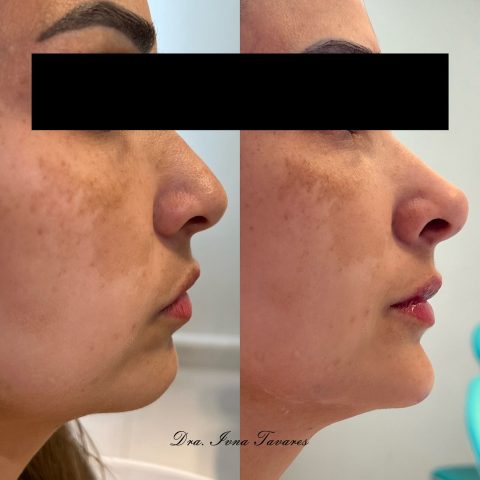 Dra. Ivna Tavares: Revolucionando a harmonização facial em Acopiara