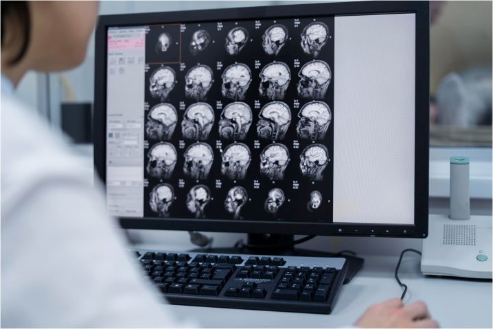A evolução da neurorradiologia como diagnóstico preciso e inovador A evolução da neurorradiologia como diagnóstico preciso e inovador
