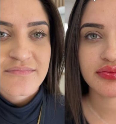 Dra. Ana Marques: Da superação à referência na harmonização orofacial Dra. Ana Marques: Da superação à referência na harmonização orofacial