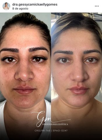 Dra. Gessyca Mickaelly, Pioneira no Tratamento do Melasma de Dentro para Fora em Roraima