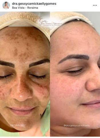 Dra. Gessyca Mickaelly, Pioneira no Tratamento do Melasma de Dentro para Fora em Roraima